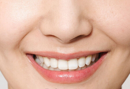 美白牙齒的自然方法(2)